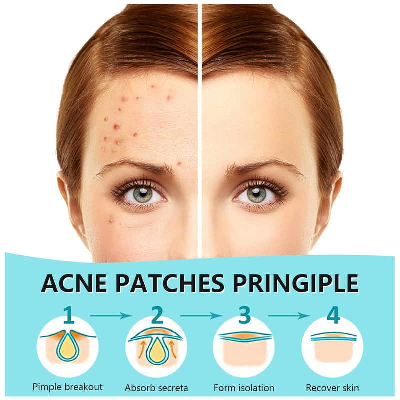 180 Counts Pimple Patches for Face Hydrocolloid Acne Patches for Face Invisible